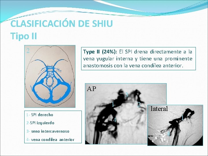 CLASIFICACIÓN DE SHIU Tipo II 2 Type II (24%): El SPI drena directamente a CLASIFICACIÓN DE SHIU Tipo II 2 Type II (24%): El SPI drena directamente a