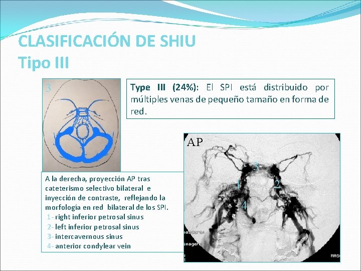 CLASIFICACIÓN DE SHIU Tipo III 23 Type III (24%): El SPI está distribuido por CLASIFICACIÓN DE SHIU Tipo III 23 Type III (24%): El SPI está distribuido por