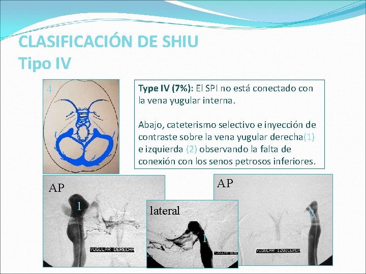 CLASIFICACIÓN DE SHIU Tipo IV Type IV (7%): El SPI no está conectado con CLASIFICACIÓN DE SHIU Tipo IV Type IV (7%): El SPI no está conectado con