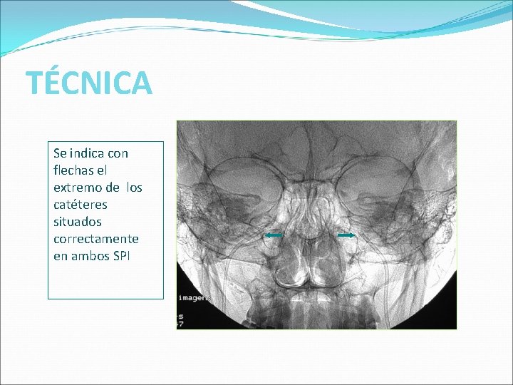 TÉCNICA Se indica con flechas el extremo de los catéteres situados correctamente en ambos TÉCNICA Se indica con flechas el extremo de los catéteres situados correctamente en ambos