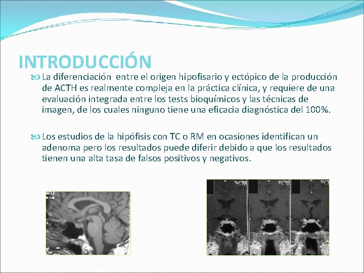 INTRODUCCIÓN La diferenciación entre el origen hipofisario y ectópico de la producción de ACTH INTRODUCCIÓN La diferenciación entre el origen hipofisario y ectópico de la producción de ACTH