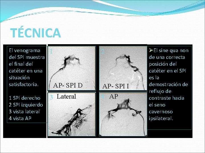 TÉCNICA El venograma del SPI muestra el final del catéter en una situación satisfactoria. TÉCNICA El venograma del SPI muestra el final del catéter en una situación satisfactoria.