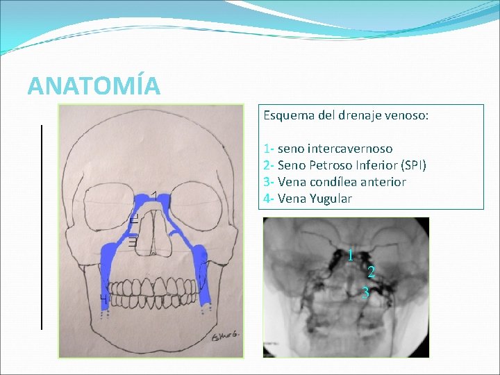 ANATOMÍA Esquema del drenaje venoso: 1 - seno intercavernoso 2 - Seno Petroso Inferior ANATOMÍA Esquema del drenaje venoso: 1 - seno intercavernoso 2 - Seno Petroso Inferior