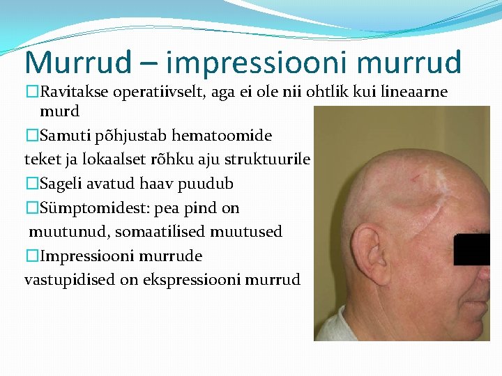 Murrud – impressiooni murrud �Ravitakse operatiivselt, aga ei ole nii ohtlik kui lineaarne murd