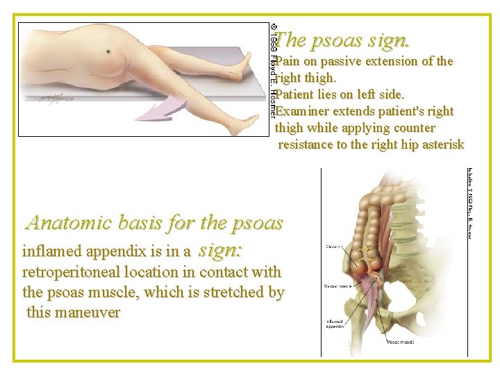 The psoas sign. Pain on passive extension of the right thigh. Patient lies on