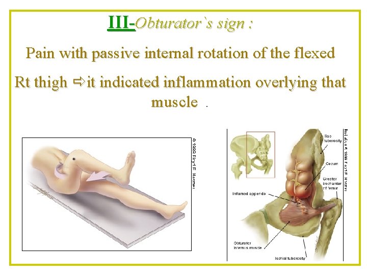 III-Obturator`s sign : Pain with passive internal rotation of the flexed Rt thigh it