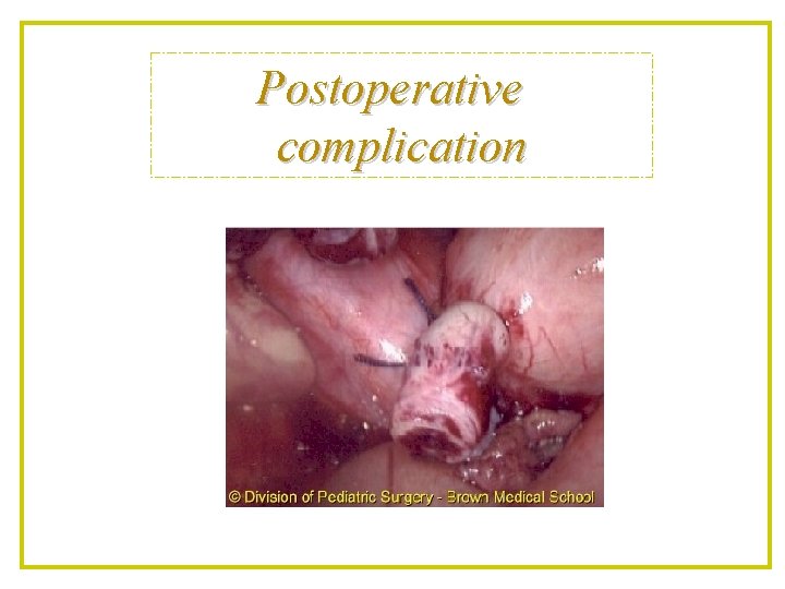 Postoperative complication 