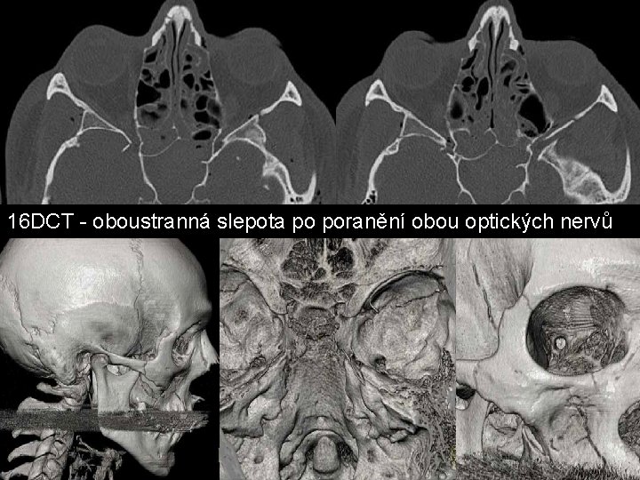 16 DCT - oboustranná slepota po poranění obou optických nervů 16 DCT - oboustranná slepota po poranění obou optických nervů