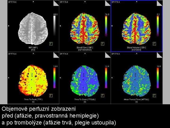 Objemové perfuzní zobrazení před (afázie, pravostranná hemiplegie) a po trombolýze (afázie trvá, plegie ustoupila) Objemové perfuzní zobrazení před (afázie, pravostranná hemiplegie) a po trombolýze (afázie trvá, plegie ustoupila)