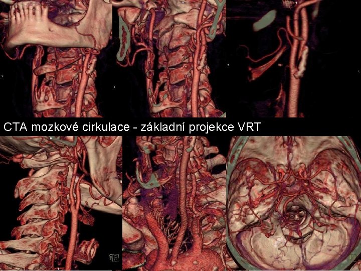 CTA mozkové cirkulace - základní projekce VRT CTA mozkové cirkulace - základní projekce VRT