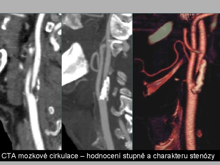 CTA mozkové cirkulace – hodnocení stupně a charakteru stenózy CTA mozkové cirkulace – hodnocení stupně a charakteru stenózy