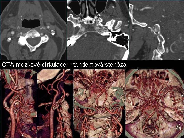 CTA mozkové cirkulace – tandemová stenóza CTA mozkové cirkulace – tandemová stenóza
