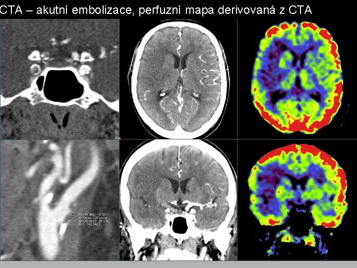 CTA – akutní embolizace, perfuzní mapa derivovaná z CTA CTA – akutní embolizace, perfuzní mapa derivovaná z CTA