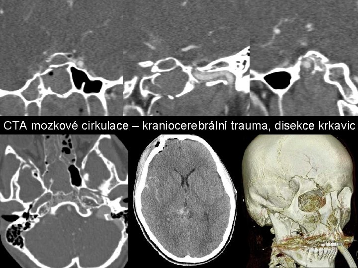 CTA mozkové cirkulace – kraniocerebrální trauma, disekce krkavic CTA mozkové cirkulace – kraniocerebrální trauma, disekce krkavic