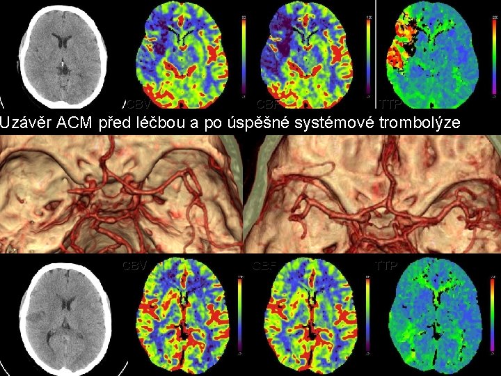 CBV CBF TTP Uzávěr ACM před léčbou a po úspěšné systémové trombolýze CBV CBF CBV CBF TTP Uzávěr ACM před léčbou a po úspěšné systémové trombolýze CBV CBF