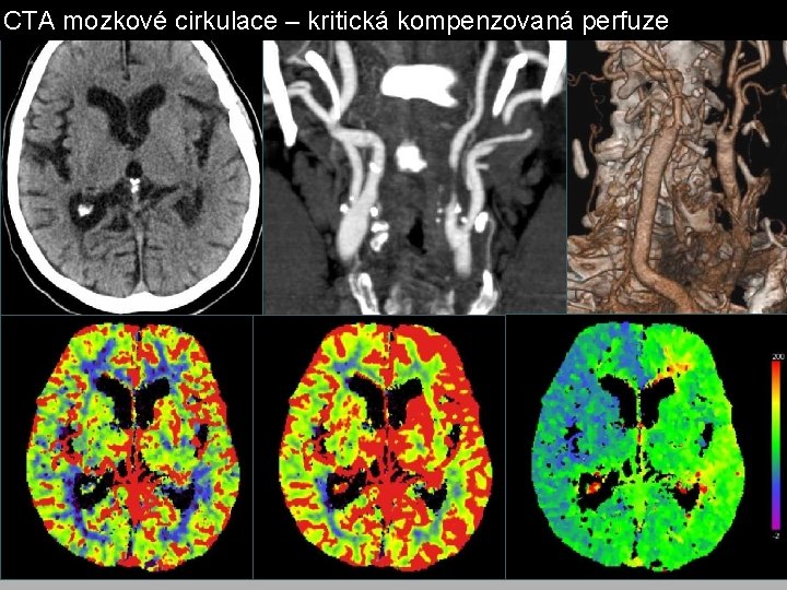 CTA mozkové cirkulace – kritická kompenzovaná perfuze CTA mozkové cirkulace – kritická kompenzovaná perfuze