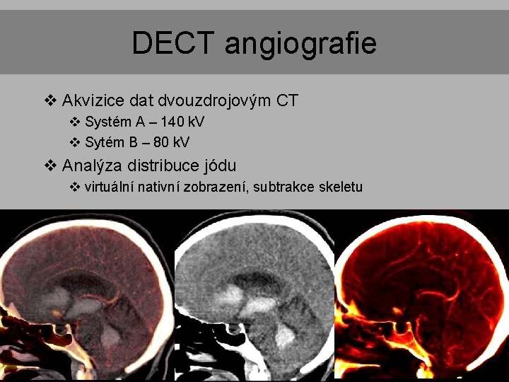 DECT angiografie v Akvizice dat dvouzdrojovým CT v Systém A – 140 k. V DECT angiografie v Akvizice dat dvouzdrojovým CT v Systém A – 140 k. V