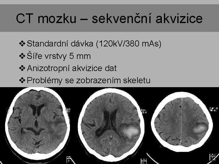 CT mozku – sekvenční akvizice v Standardní dávka (120 k. V/380 m. As) v CT mozku – sekvenční akvizice v Standardní dávka (120 k. V/380 m. As) v