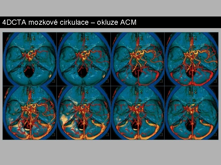 4 DCTA mozkové cirkulace – okluze ACM 4 DCTA mozkové cirkulace – okluze ACM