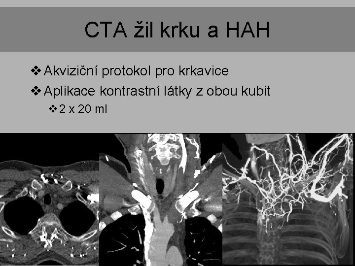 CTA žil krku a HAH v Akviziční protokol pro krkavice v Aplikace kontrastní látky CTA žil krku a HAH v Akviziční protokol pro krkavice v Aplikace kontrastní látky