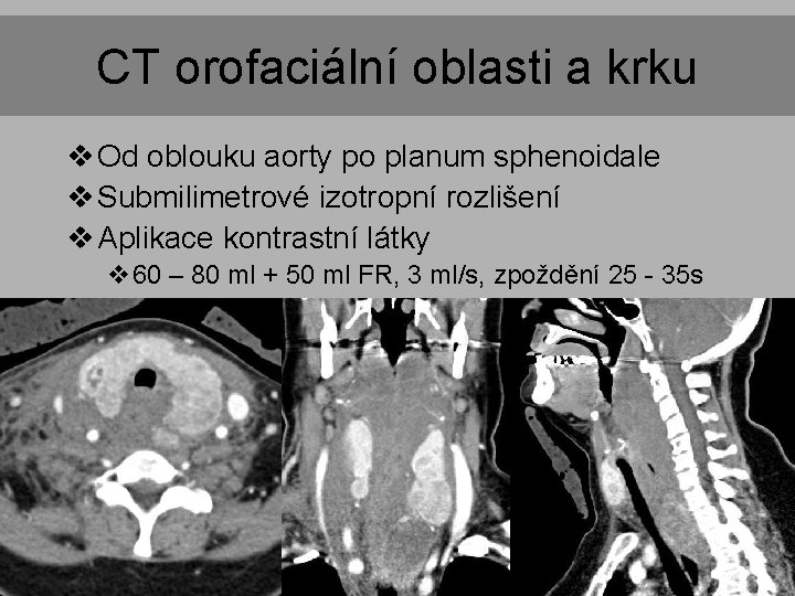 CT orofaciální oblasti a krku v Od oblouku aorty po planum sphenoidale v Submilimetrové CT orofaciální oblasti a krku v Od oblouku aorty po planum sphenoidale v Submilimetrové