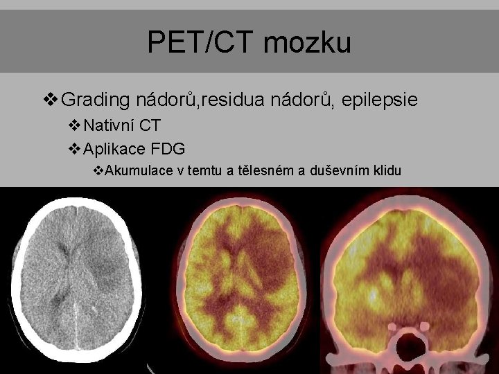 PET/CT mozku v Grading nádorů, residua nádorů, epilepsie v. Nativní CT v. Aplikace FDG PET/CT mozku v Grading nádorů, residua nádorů, epilepsie v. Nativní CT v. Aplikace FDG