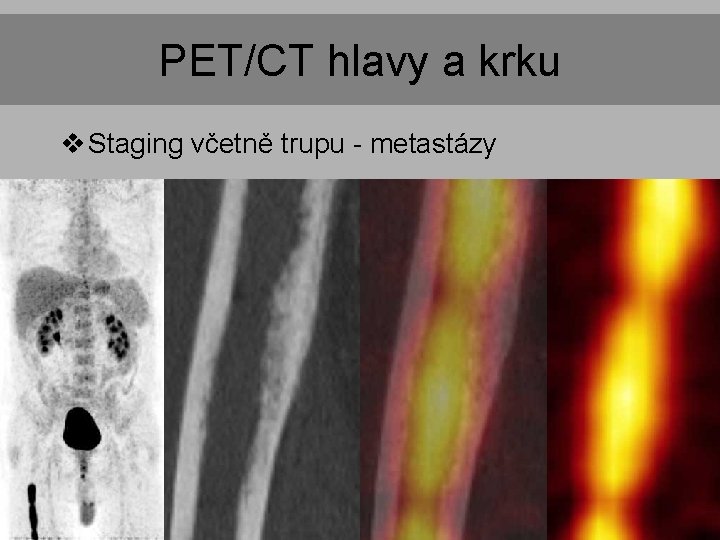 PET/CT hlavy a krku v Staging včetně trupu - metastázy PET/CT hlavy a krku v Staging včetně trupu - metastázy