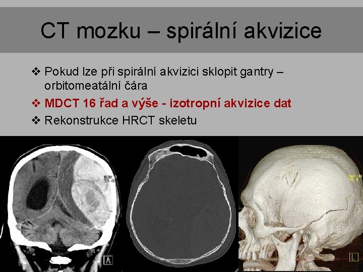 CT mozku – spirální akvizice v Pokud lze při spirální akvizici sklopit gantry – CT mozku – spirální akvizice v Pokud lze při spirální akvizici sklopit gantry –