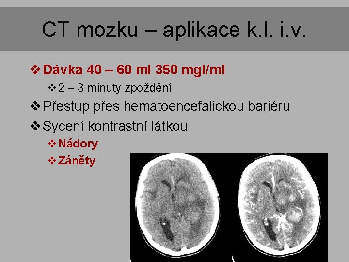CT mozku – aplikace k. l. i. v. v Dávka 40 – 60 ml CT mozku – aplikace k. l. i. v. v Dávka 40 – 60 ml
