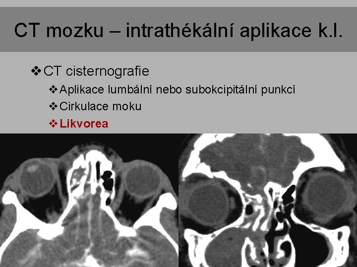 CT mozku – intrathékální aplikace k. l. v CT cisternografie v. Aplikace lumbální nebo CT mozku – intrathékální aplikace k. l. v CT cisternografie v. Aplikace lumbální nebo