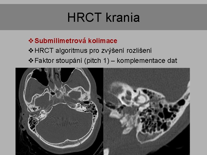 HRCT krania v. Submilimetrová kolimace v. HRCT algoritmus pro zvýšení rozlišení v. Faktor stoupání HRCT krania v. Submilimetrová kolimace v. HRCT algoritmus pro zvýšení rozlišení v. Faktor stoupání