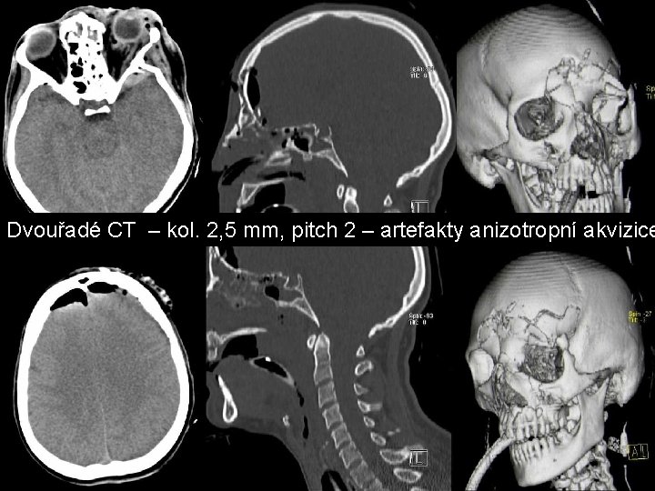 Dvouřadé CT – kol. 2, 5 mm, pitch 2 – artefakty anizotropní akvizice Dvouřadé CT – kol. 2, 5 mm, pitch 2 – artefakty anizotropní akvizice