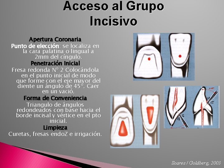 Acceso al Grupo Incisivo Apertura Coronaria Punto de elección: se localiza en la cara