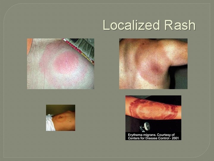 Localized Rash 