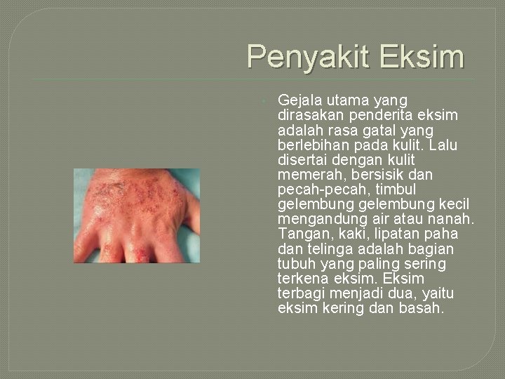 Penyakit Eksim • Gejala utama yang dirasakan penderita eksim adalah rasa gatal yang berlebihan