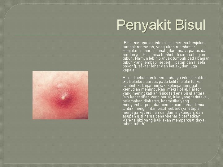 Penyakit Bisul • • Bisul merupakan infeksi kulit berupa benjolan, tampak memerah, yang akan