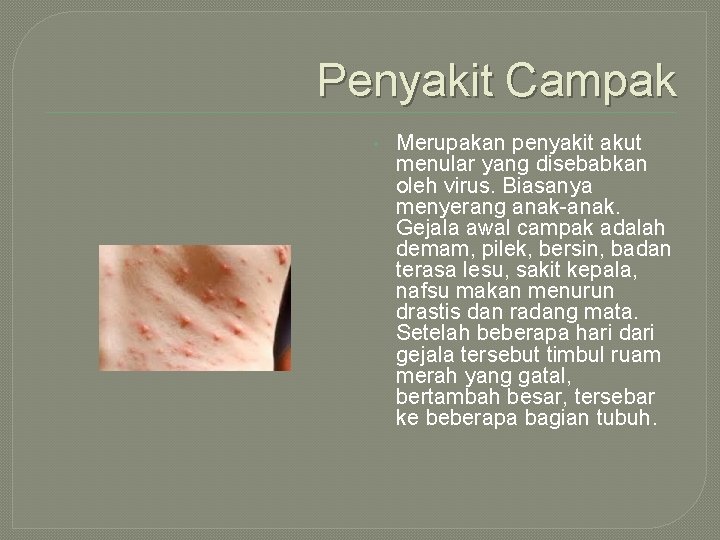 Penyakit Campak • Merupakan penyakit akut menular yang disebabkan oleh virus. Biasanya menyerang anak-anak.