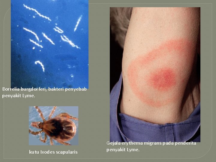 Borrelia burgdorferi, bakteri penyebab penyakit Lyme. kutu Ixodes scapularis Gejala erythema migrans pada penderita