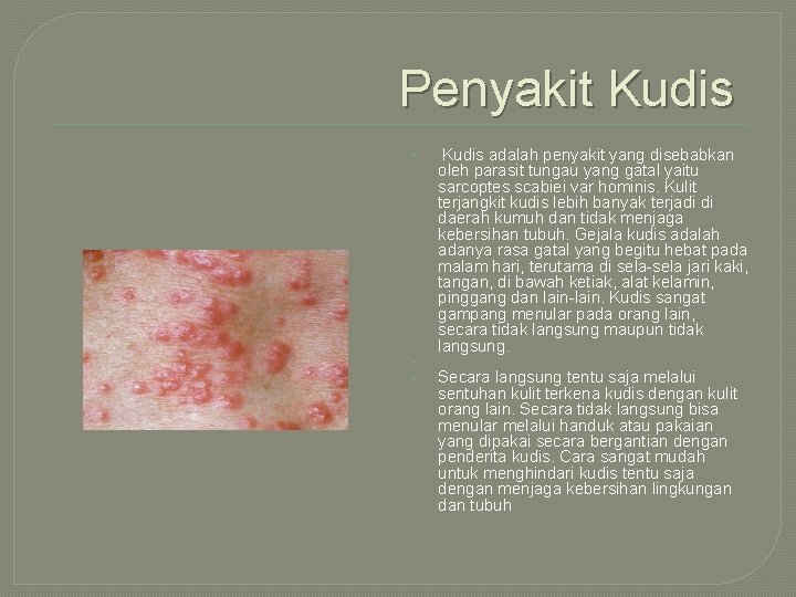 Penyakit Kudis • • • Kudis adalah penyakit yang disebabkan oleh parasit tungau yang