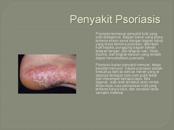 Penyakit Psoriasis • • • Psoriasis termasuk penyakit kulit yang sulit didiagnosa. Bagian tubuh