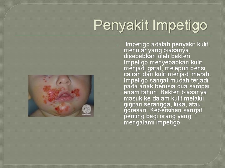 Penyakit Impetigo • Impetigo adalah penyakit kulit menular yang biasanya disebabkan oleh bakteri. Impetigo