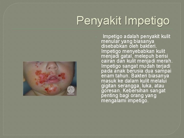 Penyakit Impetigo • Impetigo adalah penyakit kulit menular yang biasanya disebabkan oleh bakteri. Impetigo