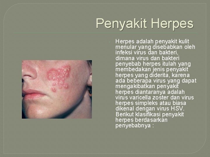 Penyakit Herpes • Herpes adalah penyakit kulit menular yang disebabkan oleh infeksi virus dan