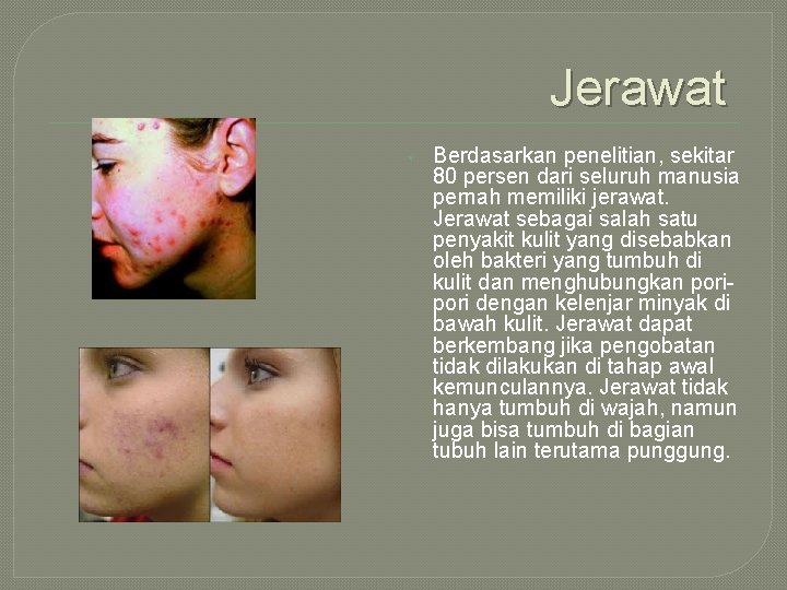 Jerawat • Berdasarkan penelitian, sekitar 80 persen dari seluruh manusia pernah memiliki jerawat. Jerawat
