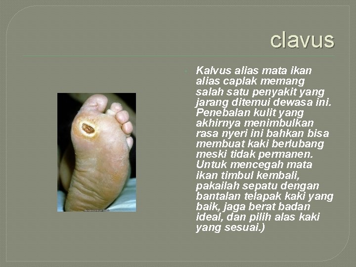 clavus • Kalvus alias mata ikan alias caplak memang salah satu penyakit yang jarang