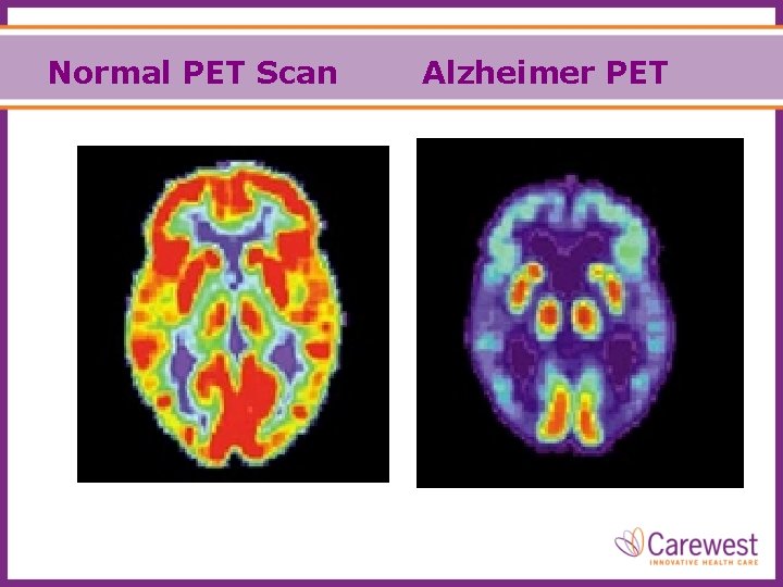 Normal PET Scan Alzheimer PET 