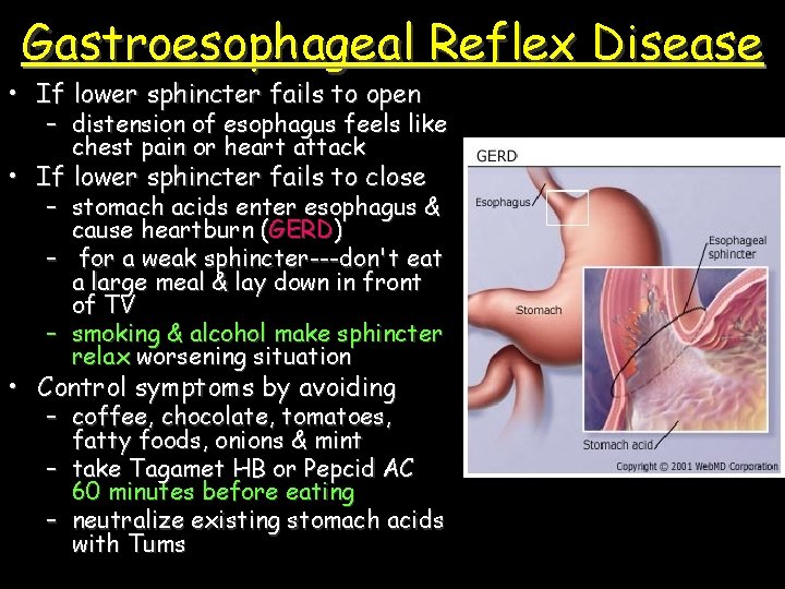 Gastroesophageal Reflex Disease • If lower sphincter fails to open – distension of esophagus