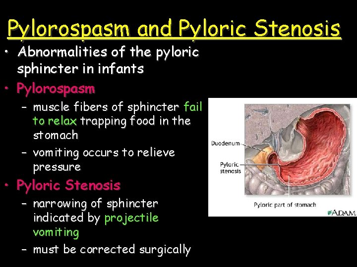 Pylorospasm and Pyloric Stenosis • Abnormalities of the pyloric sphincter in infants • Pylorospasm