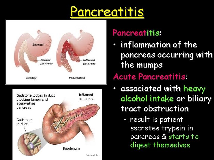 Pancreatitis: • inflammation of the pancreas occurring with the mumps Acute Pancreatitis: • associated
