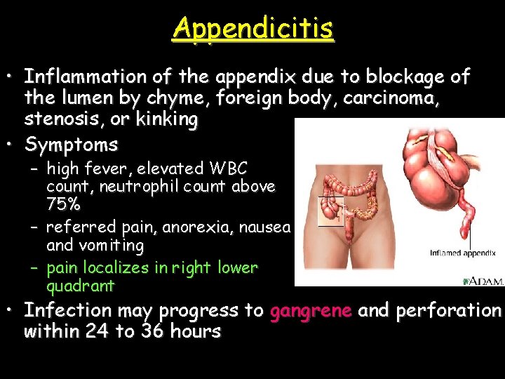 Appendicitis • Inflammation of the appendix due to blockage of the lumen by chyme,